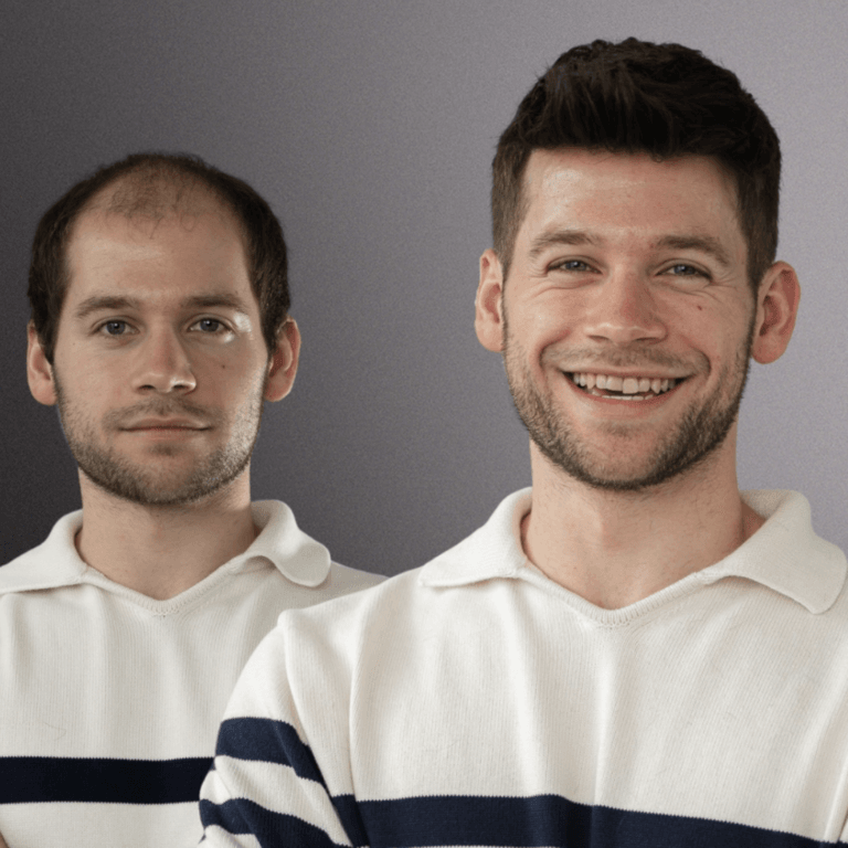Before and after non-surgical hair replacement.