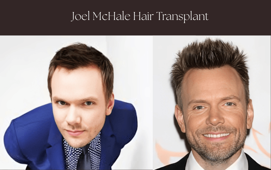 Two side-by-side images of Joel McHale, showcasing hollywood celeb with hair transplant.