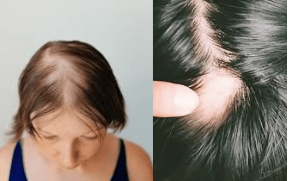Two images illustrating different alopecia hair loss patterns.