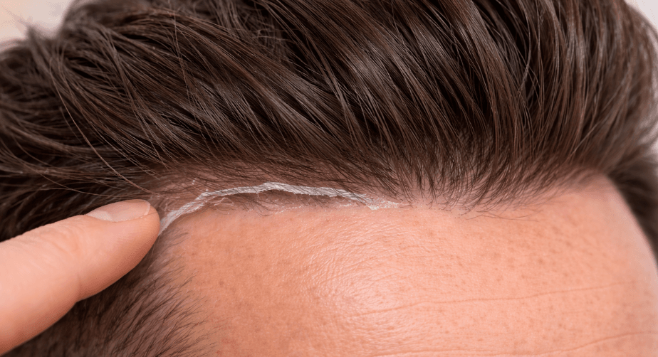 Hair System Problems: Itching, Lifting, Sweating, Shedding, and Fixes