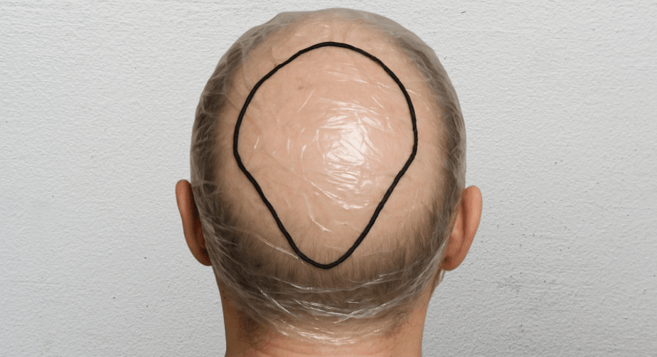 How Does a Hair System Work